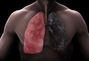Pluća i rak zbog radona