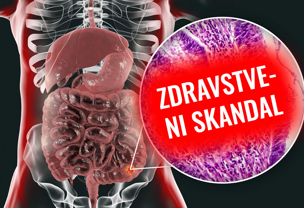 Zdravstveni skandal - Rak debelog crijeva i hrana