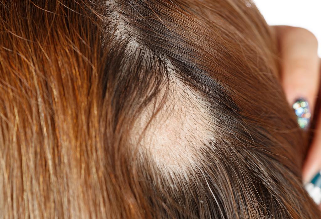 gubitak kose Alopecija areata