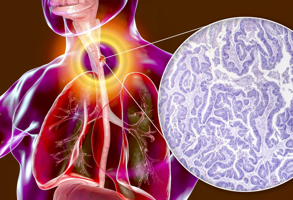 Kako spriječiti rak jednjaka