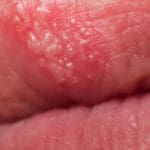 Herpes na usni - mogući lijek