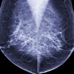 Mamografija
