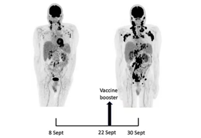 Metastaze nakon cijepljenja